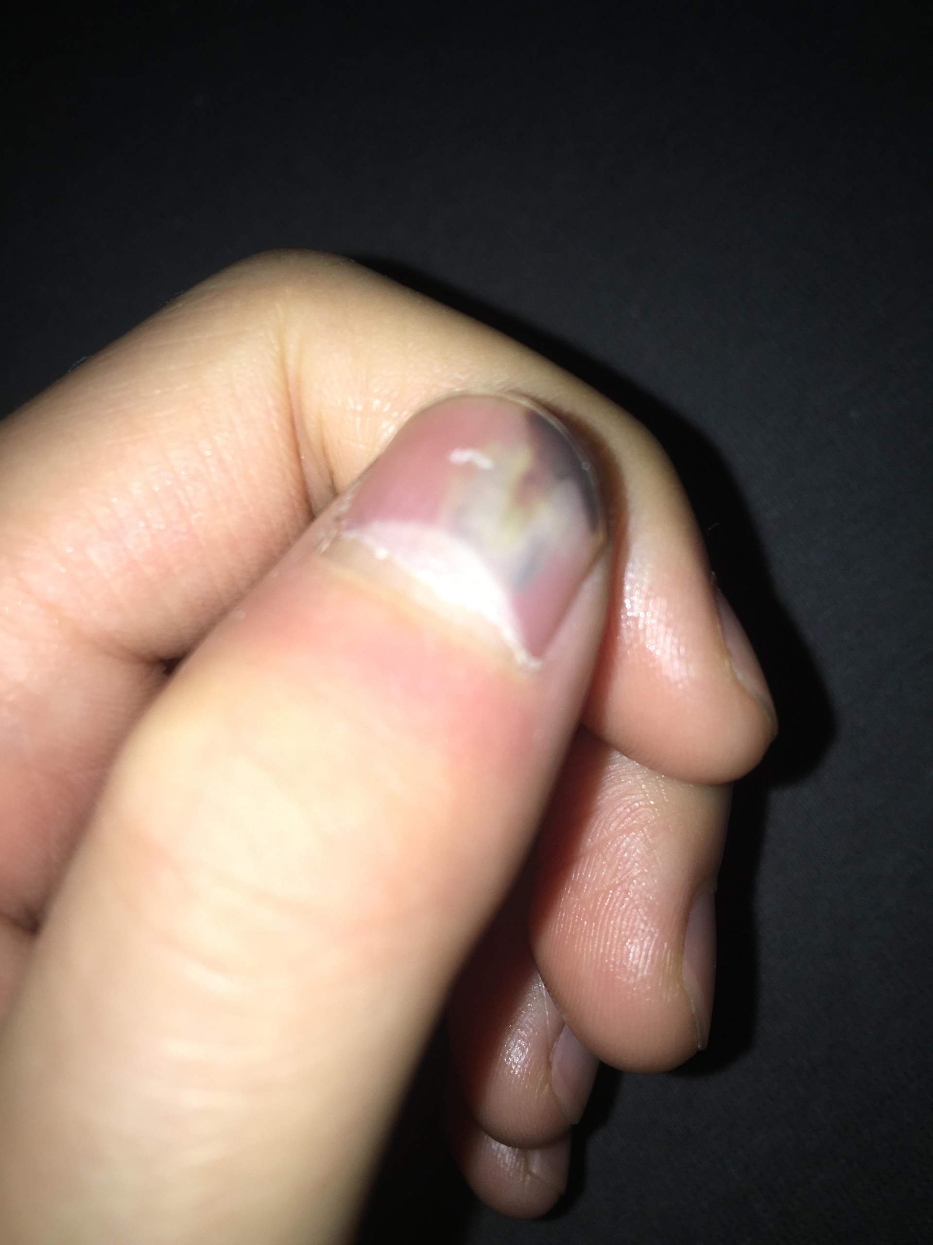 Ab wann sollten Sie bei einem Bluterguss unter dem Nagel ärztlichen Rat einholen? Ab wann sollten Sie bei einem Bluterguss unter dem Nagel ärztlichen Rat einholen?