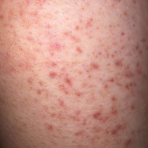 Sonnenallergie oder was ist das? (Hitze, Ausschlag)