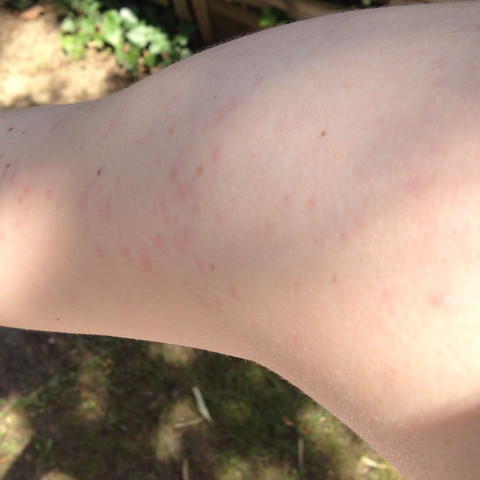 Punkte auf dem Arm die jucken - (Allergie, Sonne)