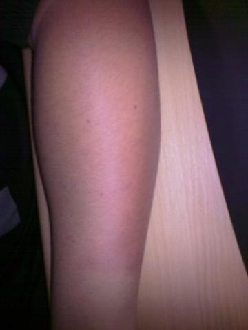 Sonnenbrand Am Arm Durch Schweissen Haut Praktikum Firma Sonnenbrand Am Arm Durch Schweissen Haut Praktikum Firma