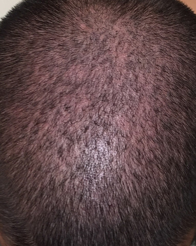 Sonnenbrand Auf Der Kopfhaut Habe Angst Das Mir Die Haare Ausfallen Haarausfall