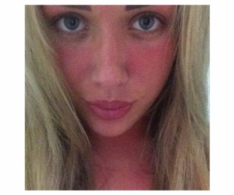 Sonnenbrand Im Gesicht Was Soll Ich Nur Machen Sonnenbrand Im Gesicht Was Soll Ich Nur Machen