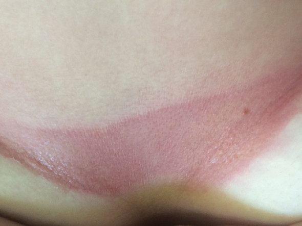 Sonnenbrand mit Eiter? - (Sonnenbrand, Gelbe Flecken)