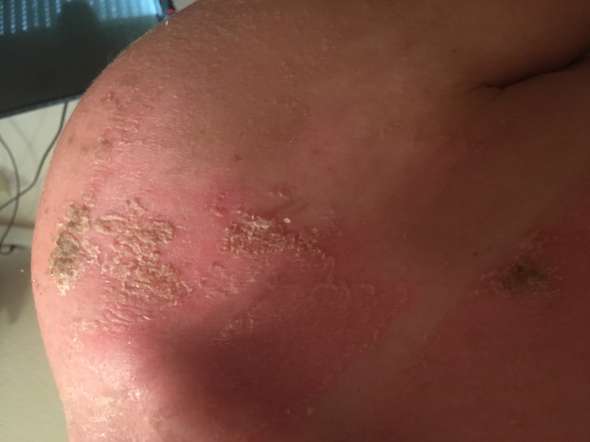 Sonnenbrand Schon Zum Arzt Korper Urlaub Haut Sonnenbrand Schon Zum Arzt Korper Urlaub Haut