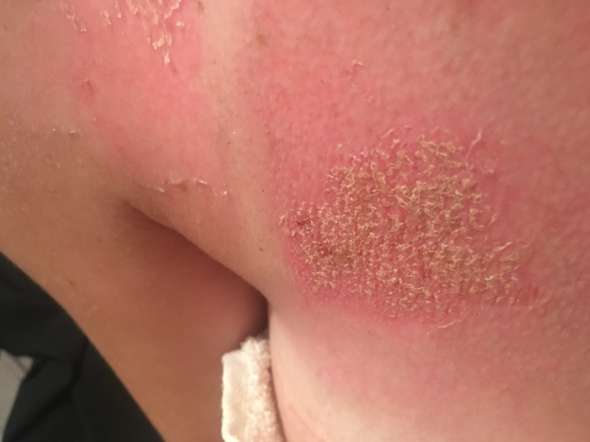 Sonnenbrand Schon Zum Arzt Korper Urlaub Haut Sonnenbrand Schon Zum Arzt Korper Urlaub Haut