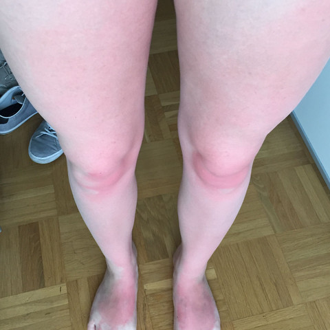 So sehen meine Beine aus, allerdings sind sie wenn man vor mir steht röter - (Schmerzen, Sonnenbrand, Advantan)