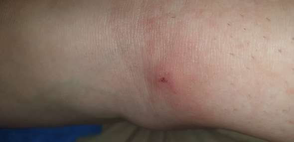 Spinnenbiss Oder Doch Nur Ein Muckenstich Gesundheit Und Medizin Insekten Entzundung