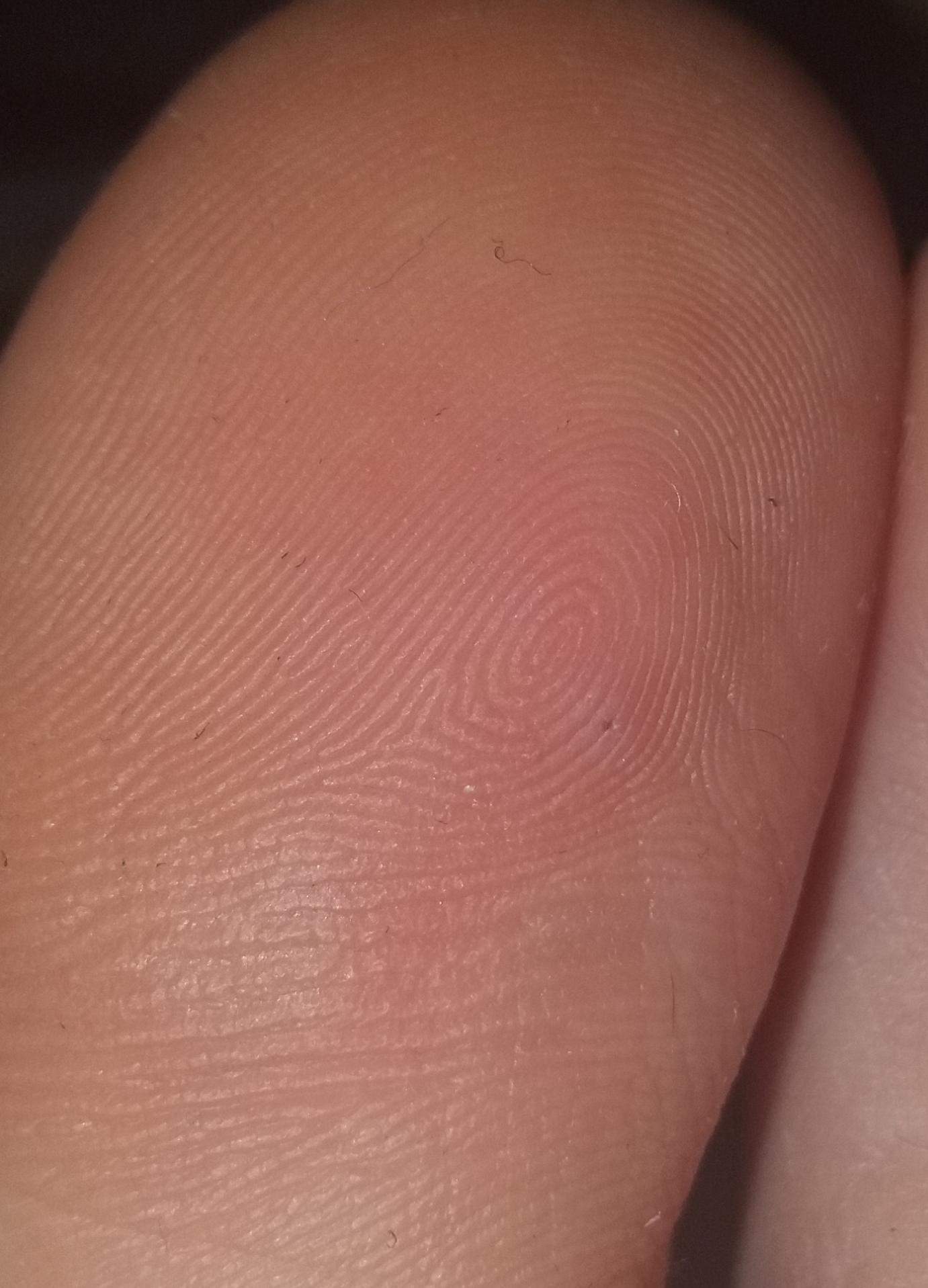 Splitter im Bein Was tun? (Gesundheit und Medizin, Gesundheit)