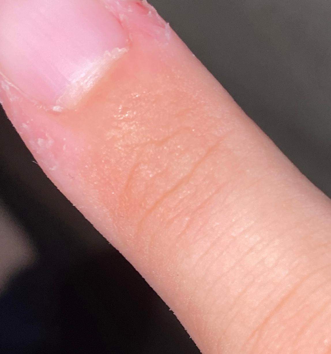 Stechen Im Finger Aber Kein Splitter Splitter im Finger? (Gesundheit und Medizin)