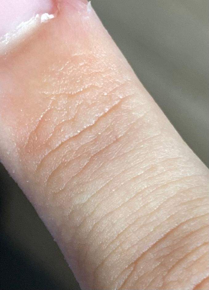 Stechen Im Finger Aber Kein Splitter Splitter im Finger? (Gesundheit und Medizin)
