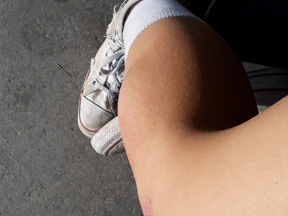 Sport Unterschenkel Beule Sport Und Fitness Verletzung Sport Unterschenkel Beule Sport Und Fitness Verletzung