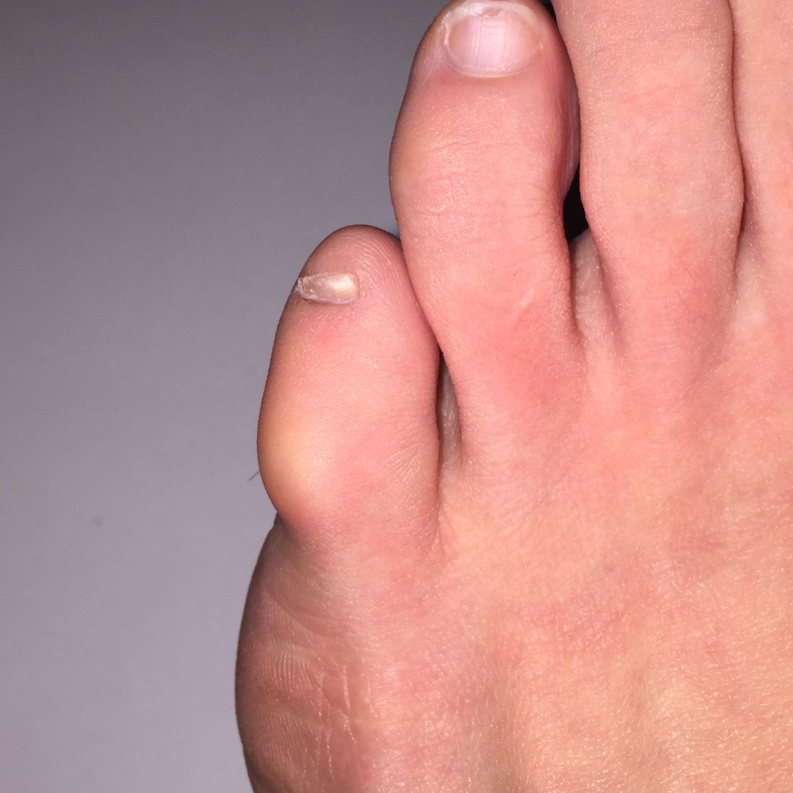 Spreizfuss, Buckel/Schwellung auf dem kleinen Zeh? (Gesundheit und Medizin, Arzt, Schmerzen) Spreizfuss, Buckel/Schwellung auf dem kleinen Zeh? (Gesundheit und Medizin, Arzt, Schmerzen)