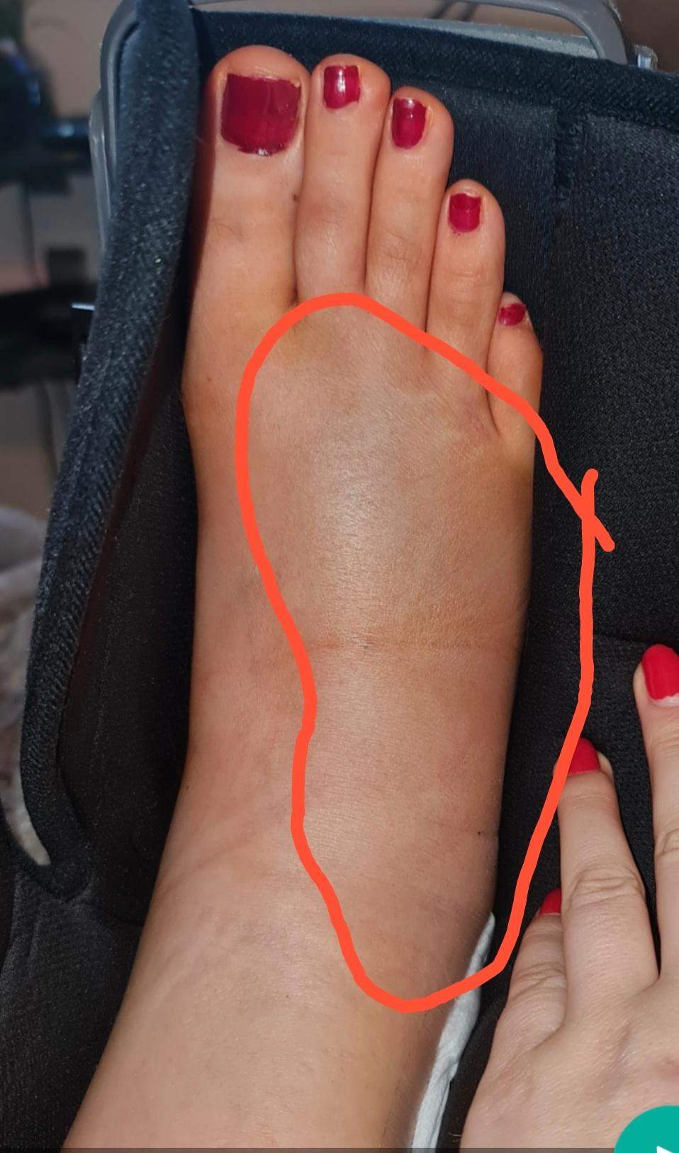 Sprunggelenk OP, Fuß teilweise taub? (Gesundheit und Medizin, Krankenhaus, Operation)