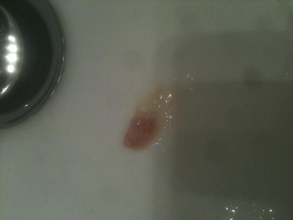 Sputum Rot Und Brockelig Krank Sputum Rot Und Brockelig Krank
