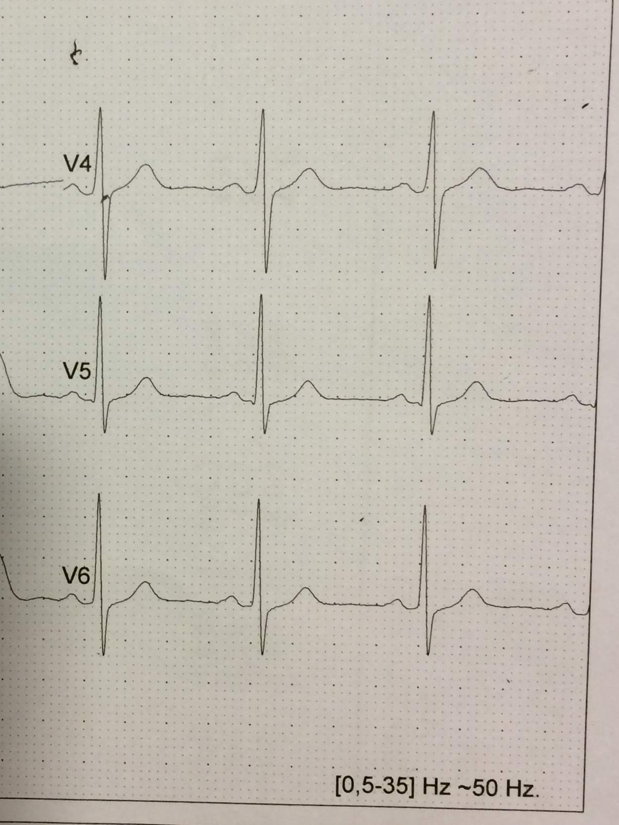 Junktionale St Senkung _ AV-Knoten-Reentrytachykardie: EKG und ...