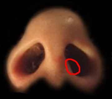 Standig Nasenbluten Nur Auf Einer Seite Medizin Arzt Nase Standig Nasenbluten Nur Auf Einer Seite Medizin Arzt Nase