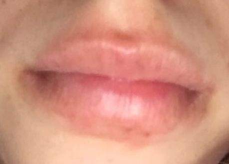 Standig Trockener Geroteter Bereich Um Den Mund Gesundheit Und Medizin Haut Standig Trockener Geroteter Bereich Um Den Mund Gesundheit Und Medizin Haut