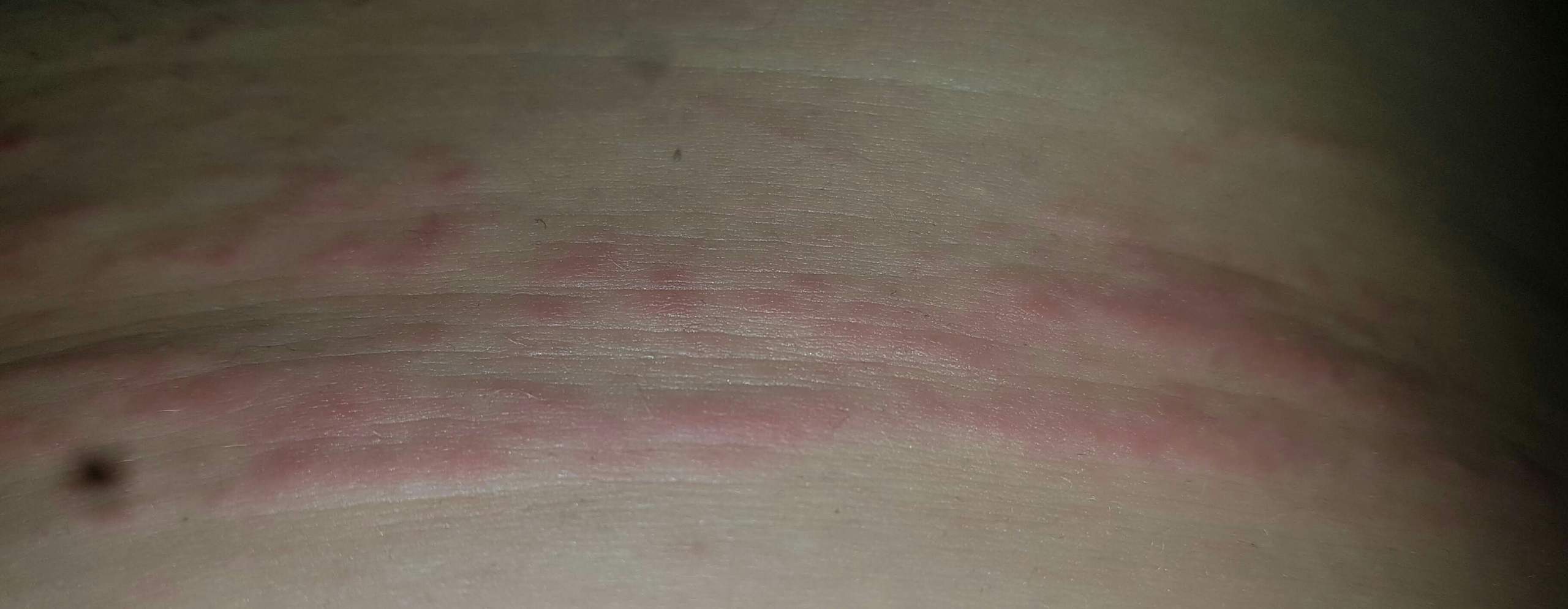 Stark juckender,nach berühren brennender Ausschlag am Bauch ...
