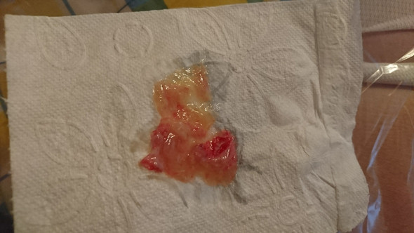 Starke Halsschmerzen Seid Monaten Mit Blutigen Auswurf Gesundheit Und Medizin Krank Hals Starke Halsschmerzen Seid Monaten Mit Blutigen Auswurf Gesundheit Und Medizin Krank Hals