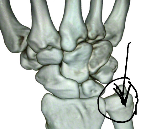 Starke Handgelenk Schmerzen Knochen Guckt Raus Trauma Nach Fahrradsturz Was Tun Chirurg Ganglion Uberbein Starke Handgelenk Schmerzen Knochen Guckt Raus Trauma Nach Fahrradsturz Was Tun Chirurg Ganglion Uberbein