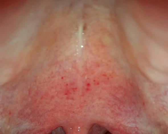 Warum Hab Ich Starke Schmerzen Am Gaumen Gesundheit Medizin Arzt Warum Hab Ich Starke Schmerzen Am Gaumen Gesundheit Medizin Arzt