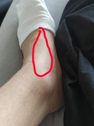 Starke Schmerzen Im Fuss Bei Langen Laufen Gesundheit Und Medizin Sport Und Fitness Fussschmerzen