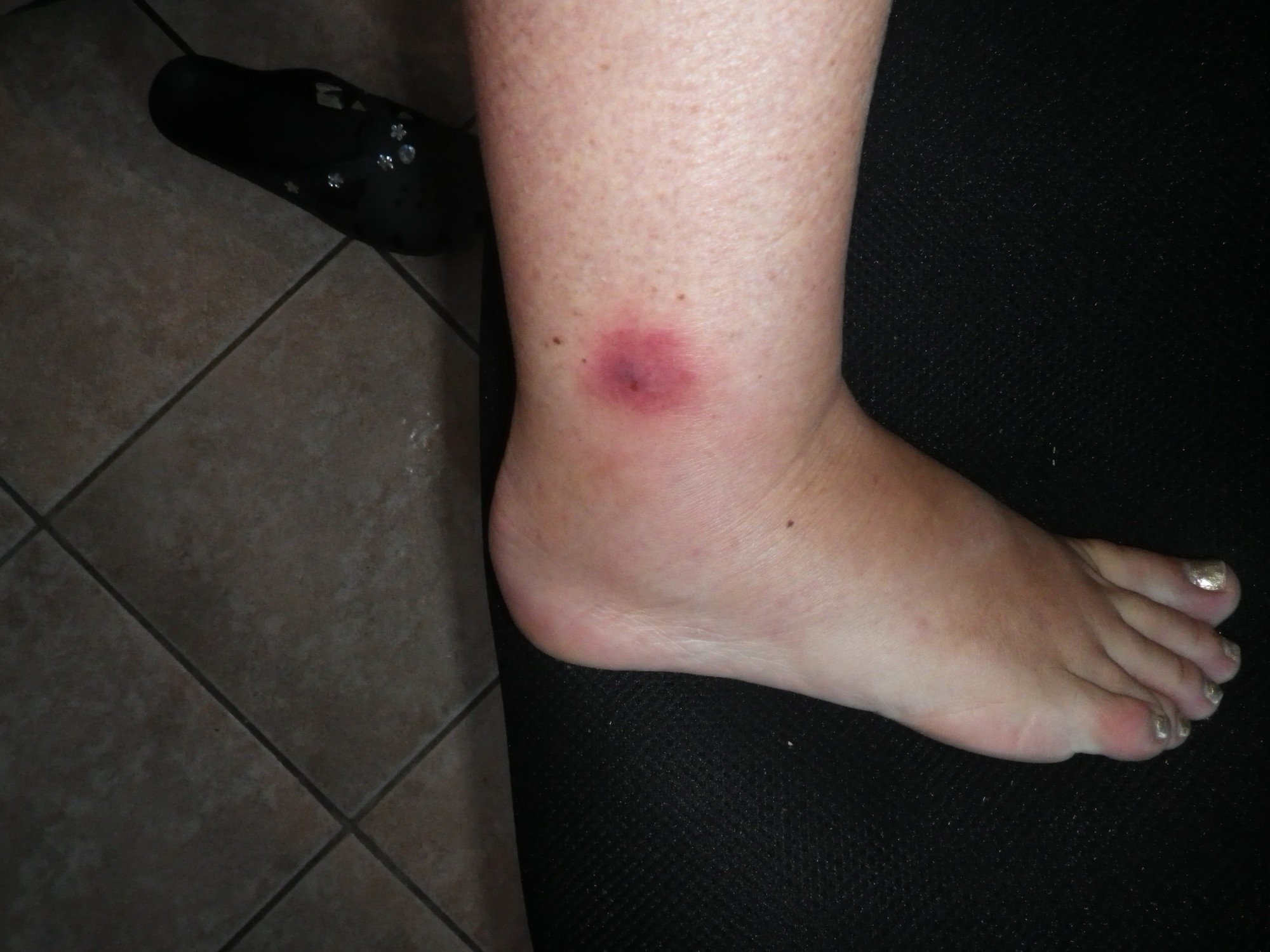 Starke schmerzen im Fußknöchel nach Mückenstich! Was kann der Arzt noch Starke schmerzen im Fußknöchel nach Mückenstich! Was kann der Arzt noch