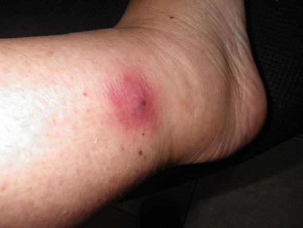 Mein Fuß Heute - (Gesundheit, Entzündung, Mückenstich)