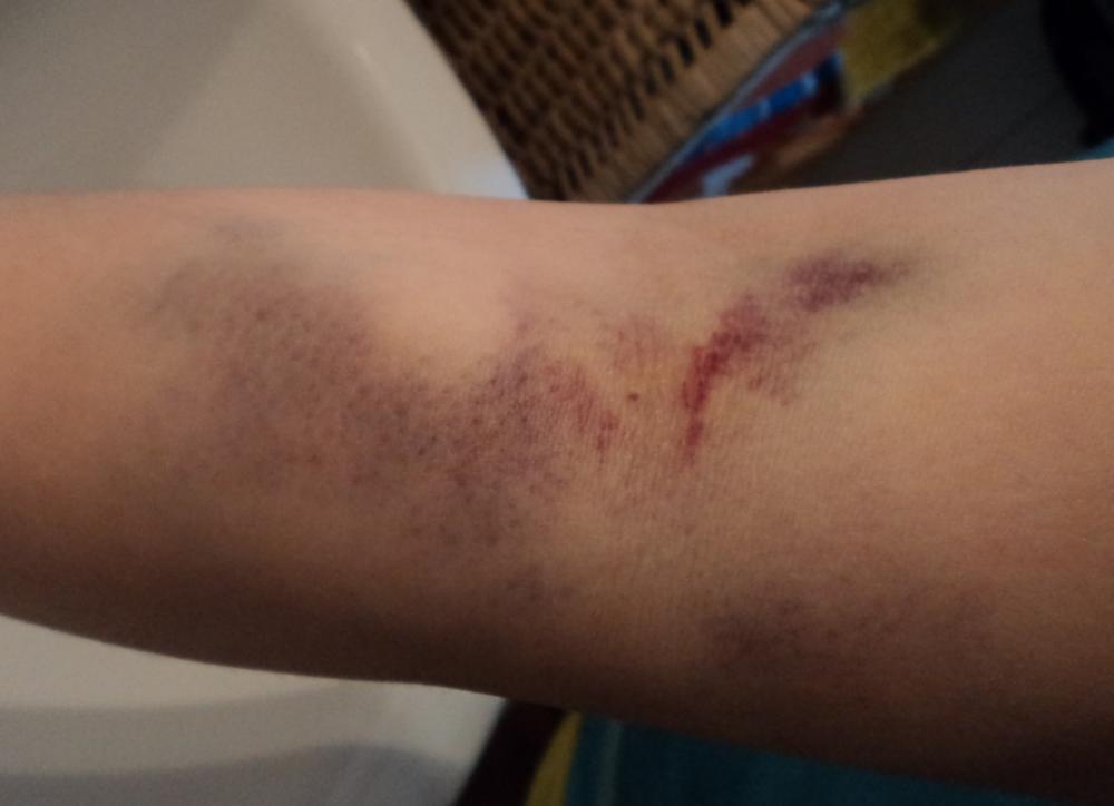 Starke Verfarbung Nach Blutabnahme Normal Korper Blut Arm Starke Verfarbung Nach Blutabnahme Normal Korper Blut Arm