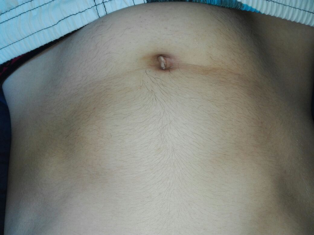 Starke Wolbung Am Bauch Durch Situps Seht Auf Den Bild Selbt Wie Kann Ich Das Wieder Wegbekommen Muskeln Sixpack Kraftsport Starke Wolbung Am Bauch Durch Situps Seht Auf Den Bild Selbt Wie Kann Ich Das Wieder Wegbekommen Muskeln Sixpack Kraftsport