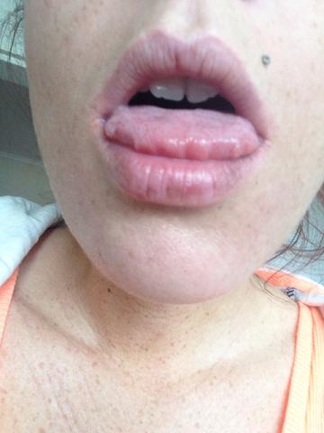 29+ Pickel Auf Der Zunge Schmerzen Images