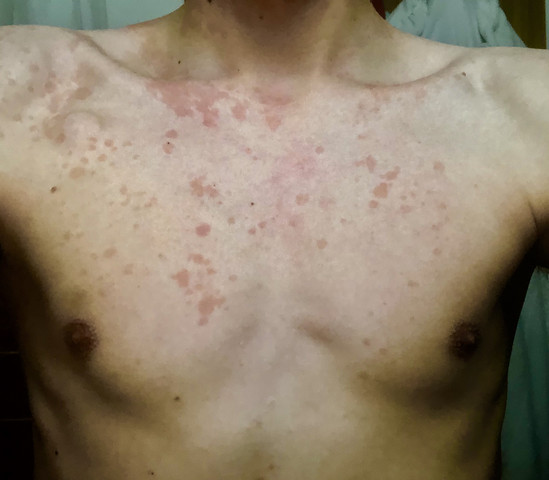 Starker Ausschlag Auf Brust Und Rucken Gesundheit Und Medizin Medizin Starker Ausschlag Auf Brust Und Rucken Gesundheit Und Medizin Medizin