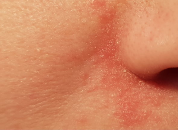 Starker Ausschlag Im Gesicht Nase Mund Und Augen Winkel Gesundheit Und Medizin Medizin Haut Starker Ausschlag Im Gesicht Nase Mund Und Augen Winkel Gesundheit Und Medizin Medizin Haut