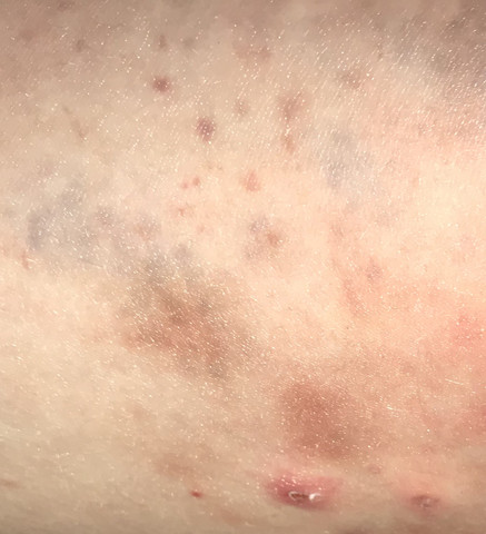 Was Kann Ich Gegen Diesen Starken Juckreiz Tun Gesundheit Und Medizin Schmerzen Was Kann Ich Gegen Diesen Starken Juckreiz Tun Gesundheit Und Medizin Schmerzen