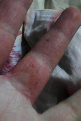 Hand - (Gesundheit, Krankheit, Haut)