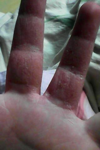 hand2 - (Gesundheit, Krankheit, Haut)