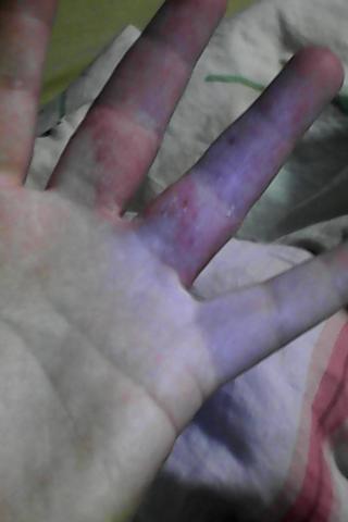 hand 4 - (Gesundheit, Krankheit, Haut)