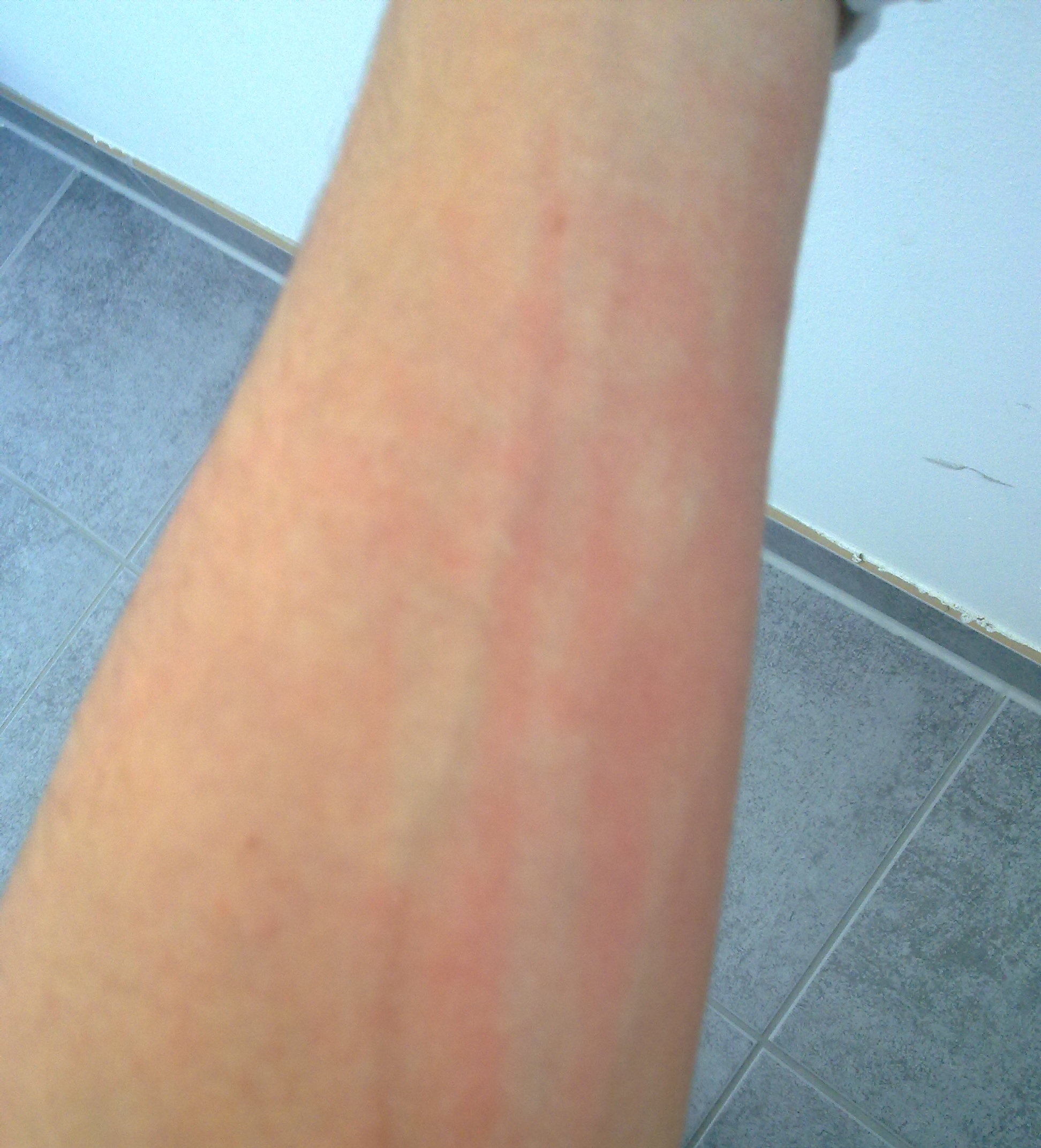 Statt schwitzen starkes jucken ( nur im winter! ) . (Haut, Juckreiz)