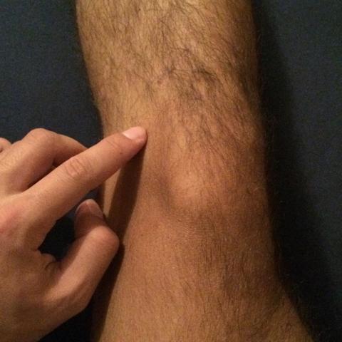 Stechen Im Knie Nach Einer Kreuzband Op 6 Monate Fussball Training Kreuzbandriss Stechen Im Knie Nach Einer Kreuzband Op 6 Monate Fussball Training Kreuzbandriss