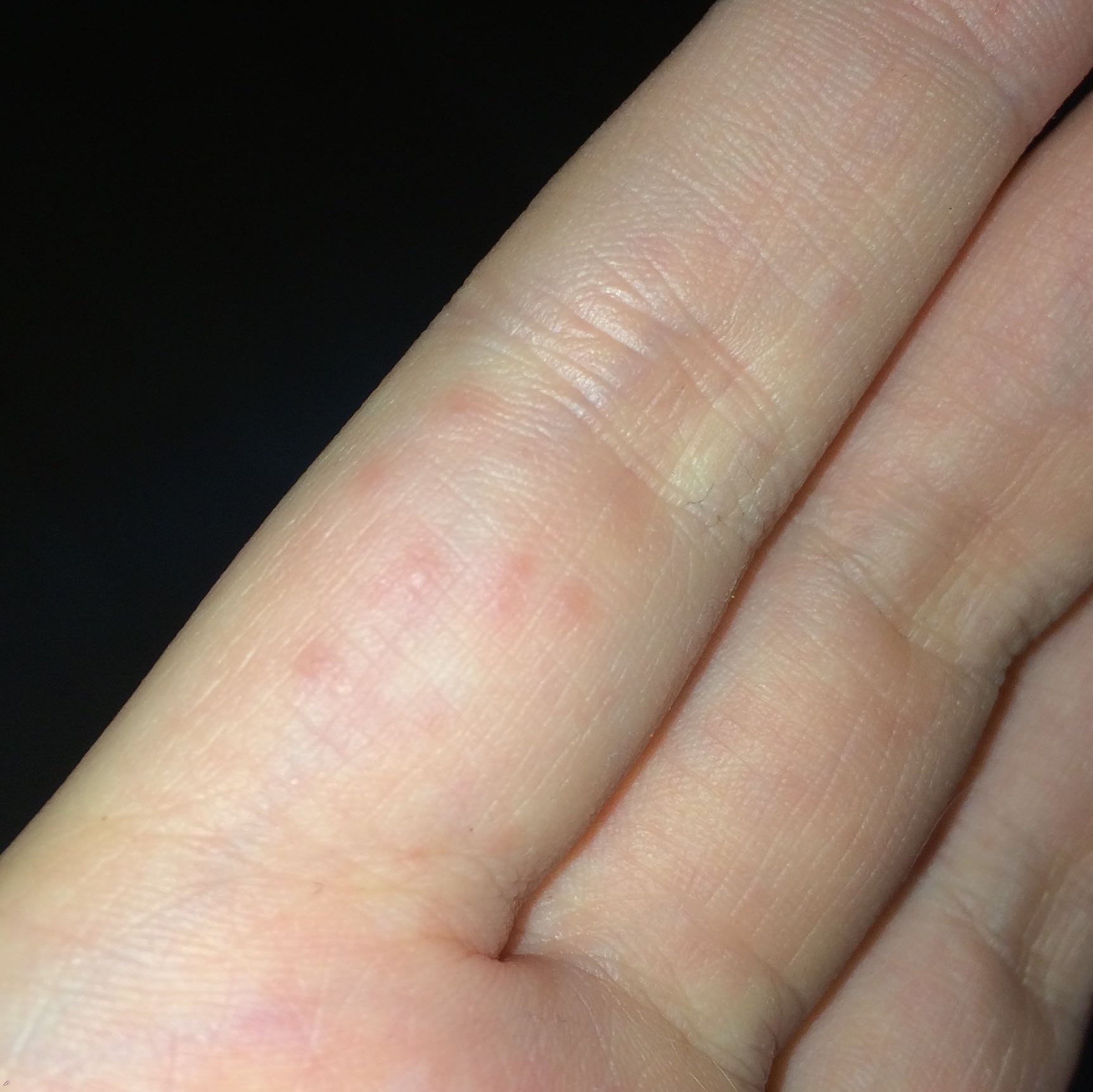 Stechende Pickelchen am Finger (Gesundheit, Arzt, Haut) Stechende Pickelchen am Finger (Gesundheit, Arzt, Haut)