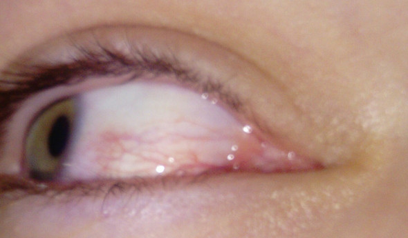 Stechen Zwicken Im Auge Gesundheit Und Medizin Schmerzen Augen Stechen Zwicken Im Auge Gesundheit Und Medizin Schmerzen Augen