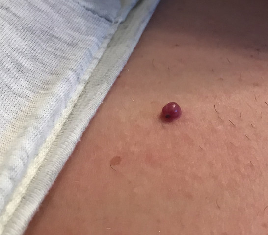 Stecknadelgrosser Roter Fleck Auf Brust M Gesundheit Und Medizin Muttermal Gewachs Stecknadelgrosser Roter Fleck Auf Brust M Gesundheit Und Medizin Muttermal Gewachs