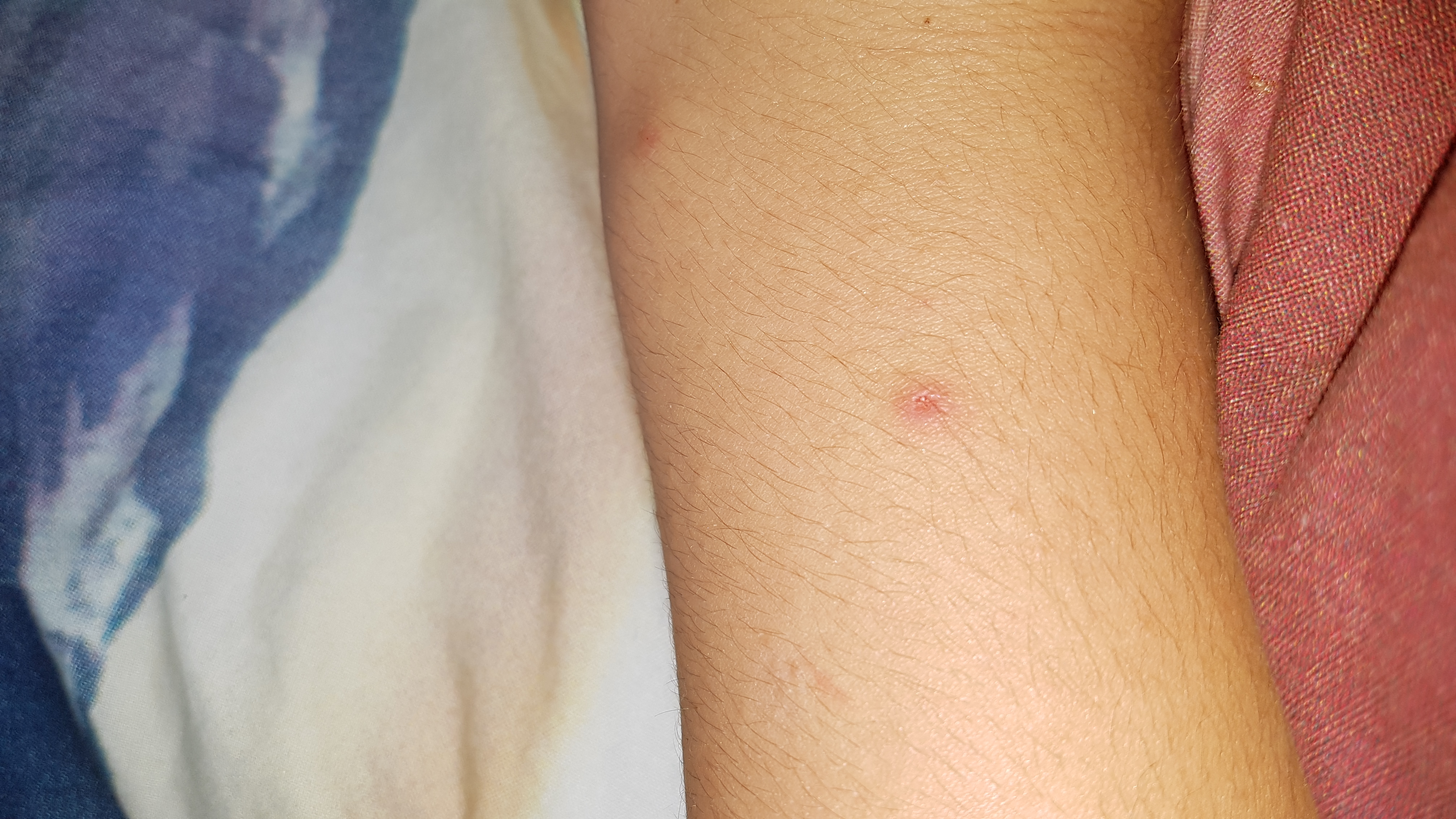 Steckt Da Noch Ein Zeckenkopf Drin Zecken Biss Blutsauger