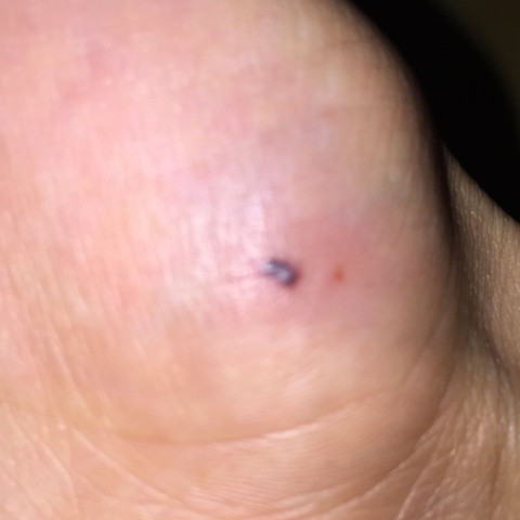 Stein in der Hand? (Medizin, Arzt, Schmerzen)
