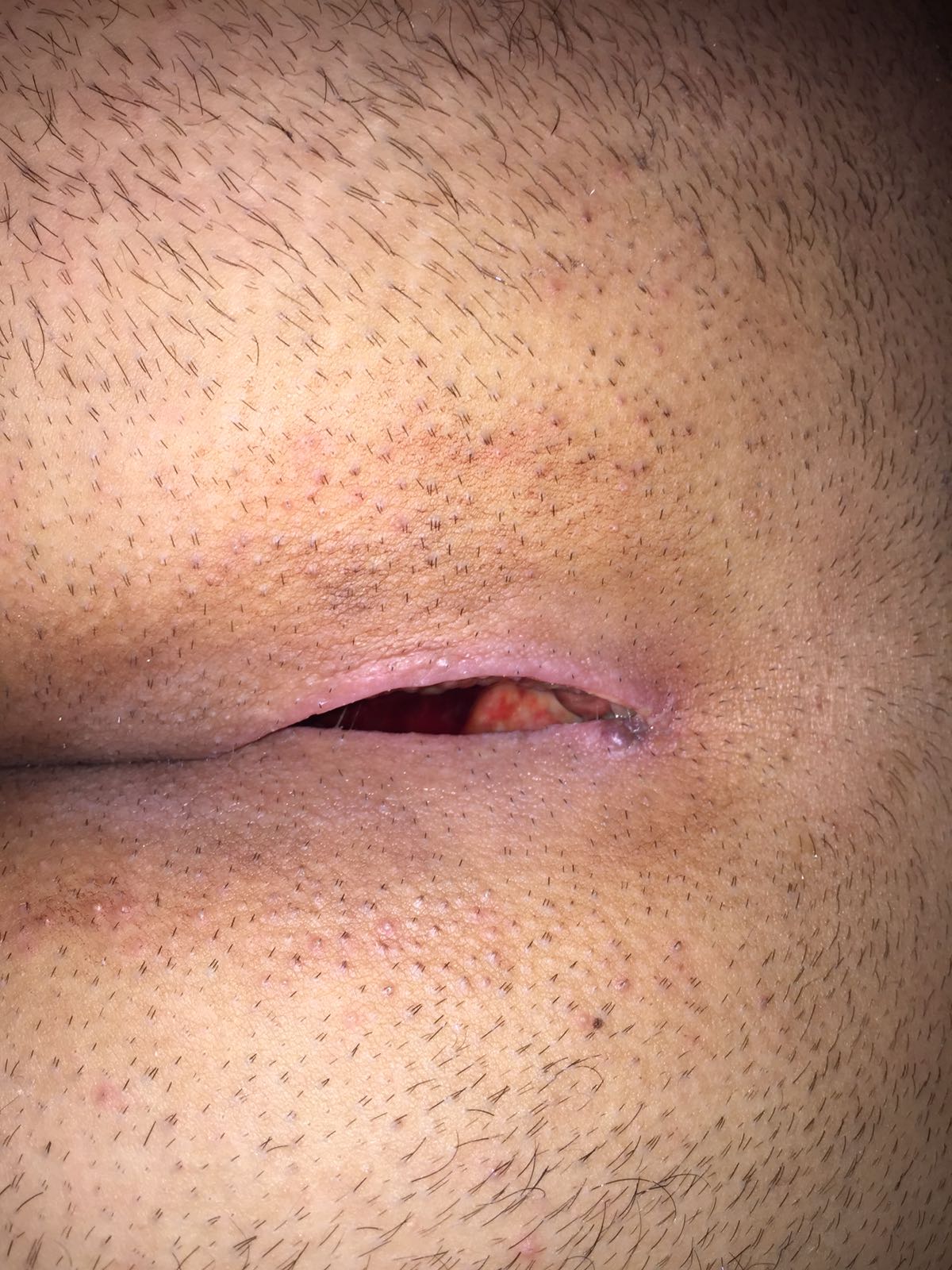 Steißbeinfistel hilfe offene wundheilung ? (Arzt, Krankheit, Wunde) Steißbeinfistel hilfe offene wundheilung ? (Arzt, Krankheit, Wunde)