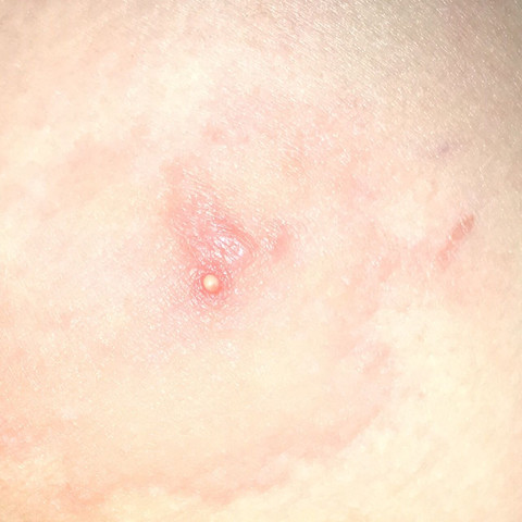 Bild 1 - (Medizin, Arzt, Entzündung)