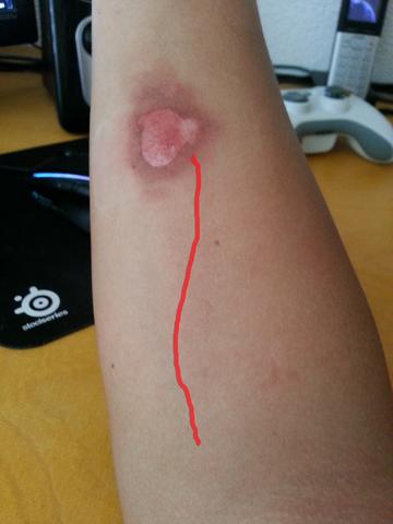 Der BlaueFleckenSchmerz ist auf der roten Linie - (Gesundheit, Schmerzen, Verbrennung)