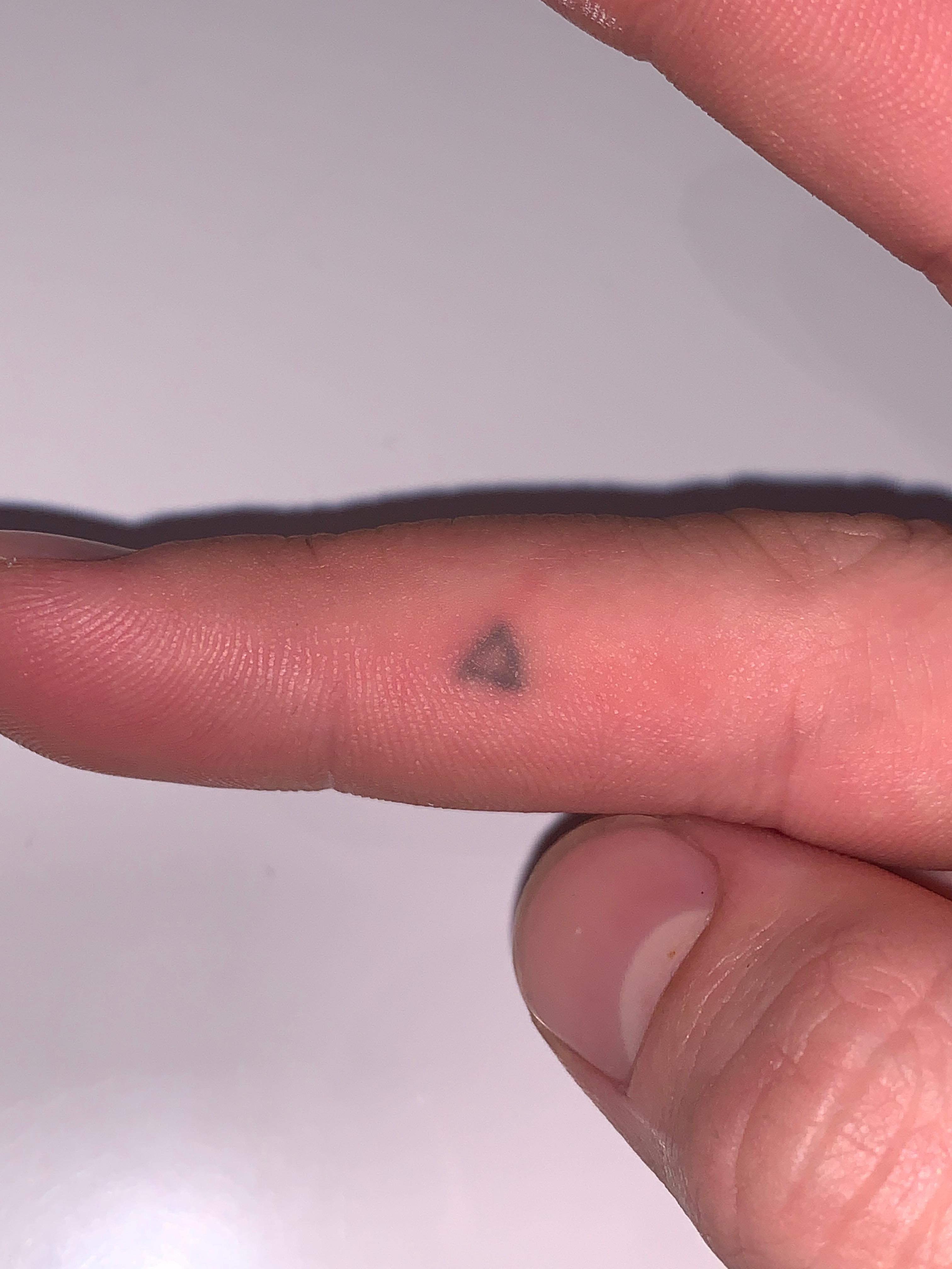 Stick 'n' Poke tattoo entfernen? (Gesundheit, Gesundheit und Medizin