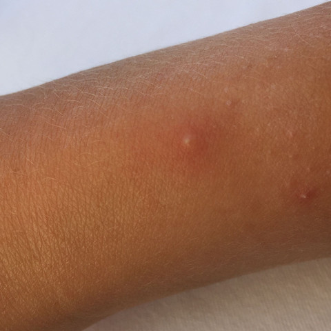 Stich oder Pikel auf der Hand? (Pickel) pickel auf der hand