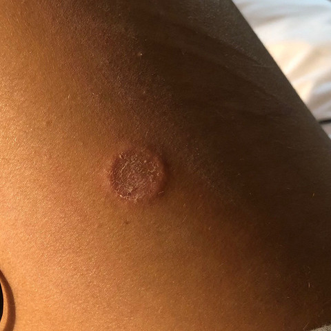 Stich und kreisrunde Erhebung der Haut? (Gesundheit und ...